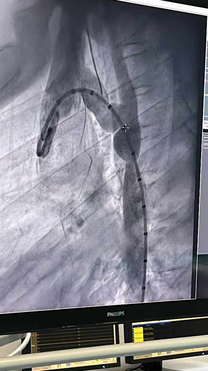 bellini_md's tweet image. Uno de los casitos de hoy: recoartación aórtica. Se manejó con anestesia general 🤩  #congenitos #hemodinamiacongenitos #anestesiacardiovascular