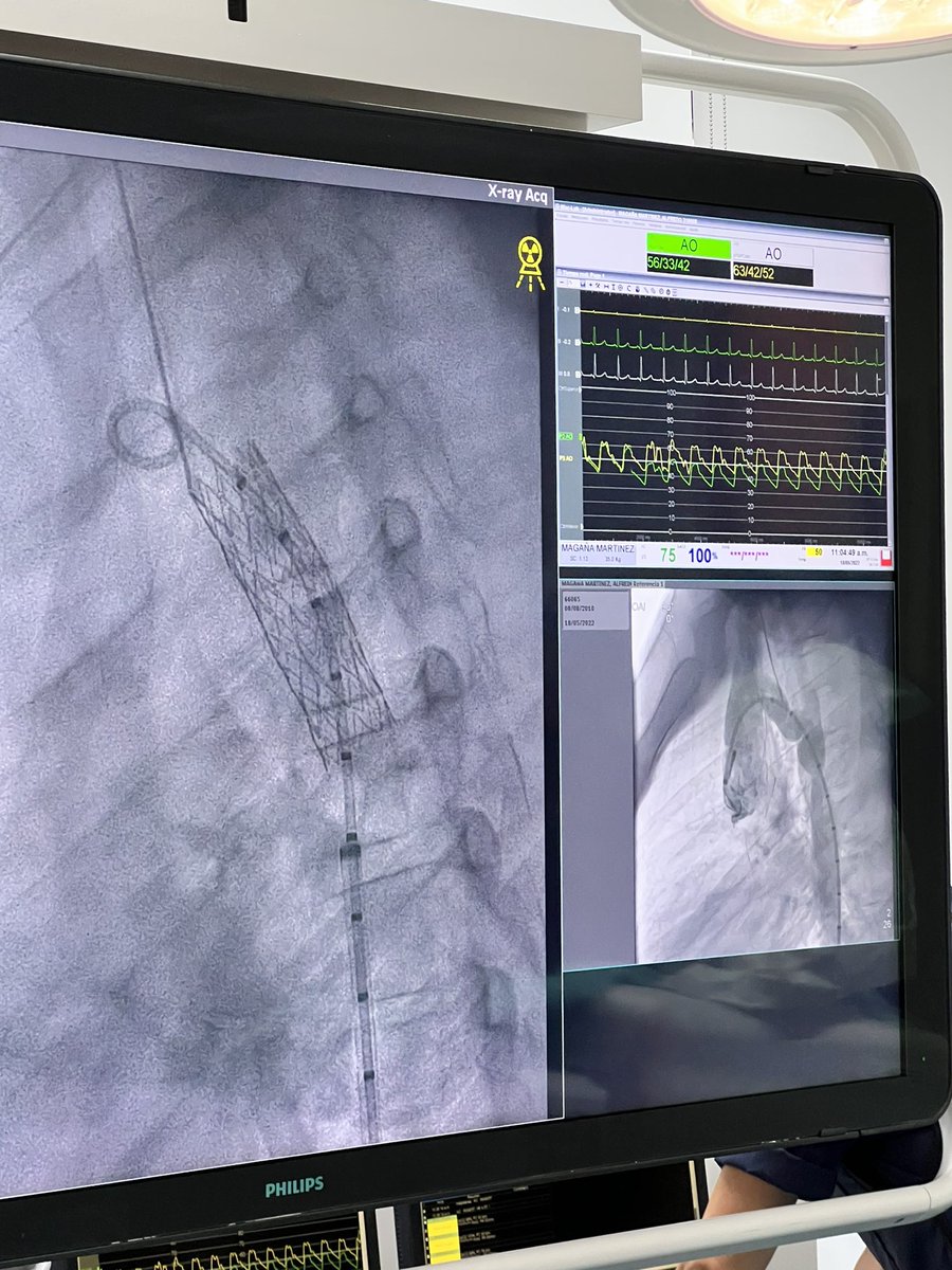 bellini_md's tweet image. Uno de los casitos de hoy: recoartación aórtica. Se manejó con anestesia general 🤩  #congenitos #hemodinamiacongenitos #anestesiacardiovascular