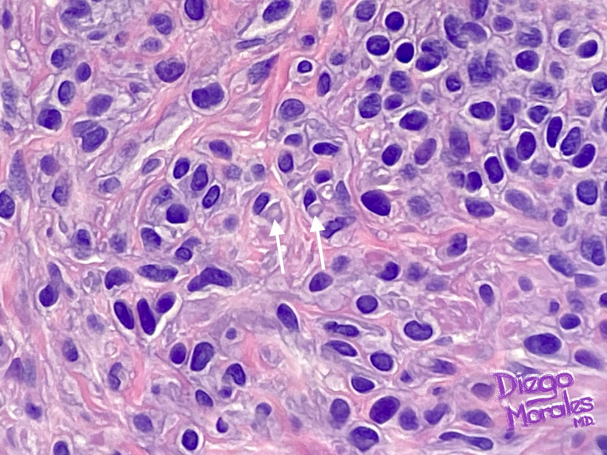 DiegoMoralesN's tweet photo. A subset of intradermal nevi, especially in heavily sun-exposed areas, seem to engulf elastotic degenerated fibers, just like happens with many SCCs.
#dermpath #pathtwitter #dermtwitter #JoyForMorfology #FreudeAnDerMorphologie #pathology #reallifedermpath #tooprettynottoshare https://t.co/09TiMckPWI