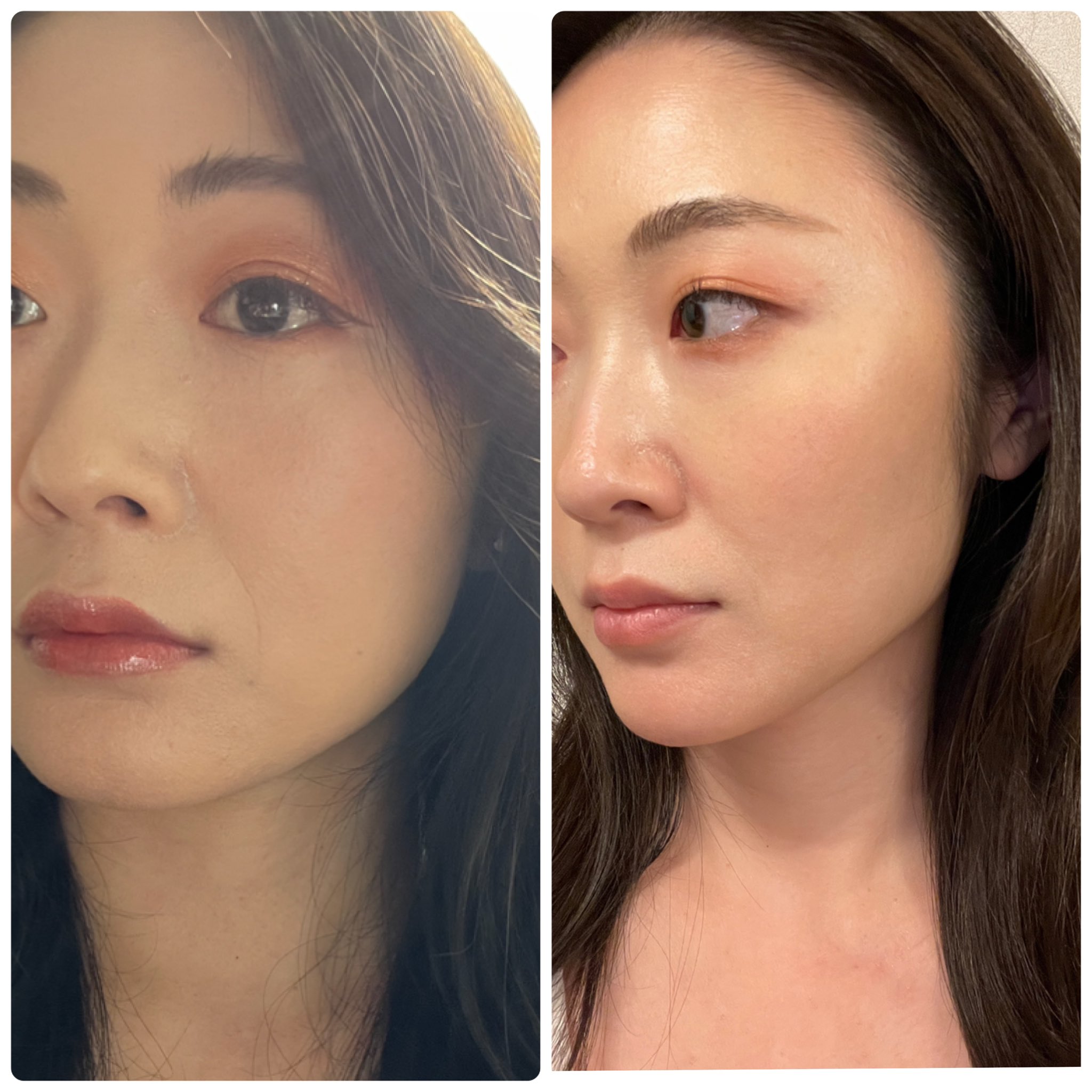 鬼軍曹ゆか様 トレーナー 10代からコンプレックスだらけで顔面見られないよう横向くことが多く15年もほうれい線 に悩んでて 思いきってヒアルロン酸いれてきました カウンセリングは先生が直接行ってくれ 骨格にあわせて理想の形になるよう超丁寧に 鬼軍曹ゆか様 トレーナー 10代からコンプレックスだらけで顔面見られないよう横向くことが多く15年もほうれい線 に悩んでて 思いきってヒアルロン酸いれてきました カウンセリングは先生が直接行ってくれ 骨格にあわせて理想の形になるよう超丁寧に