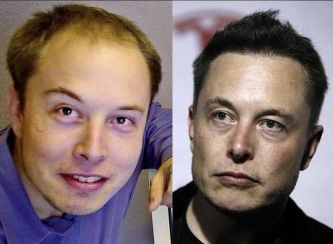 Elon Musk: Did the mogul undergo a hair transplant treatment? | Marca