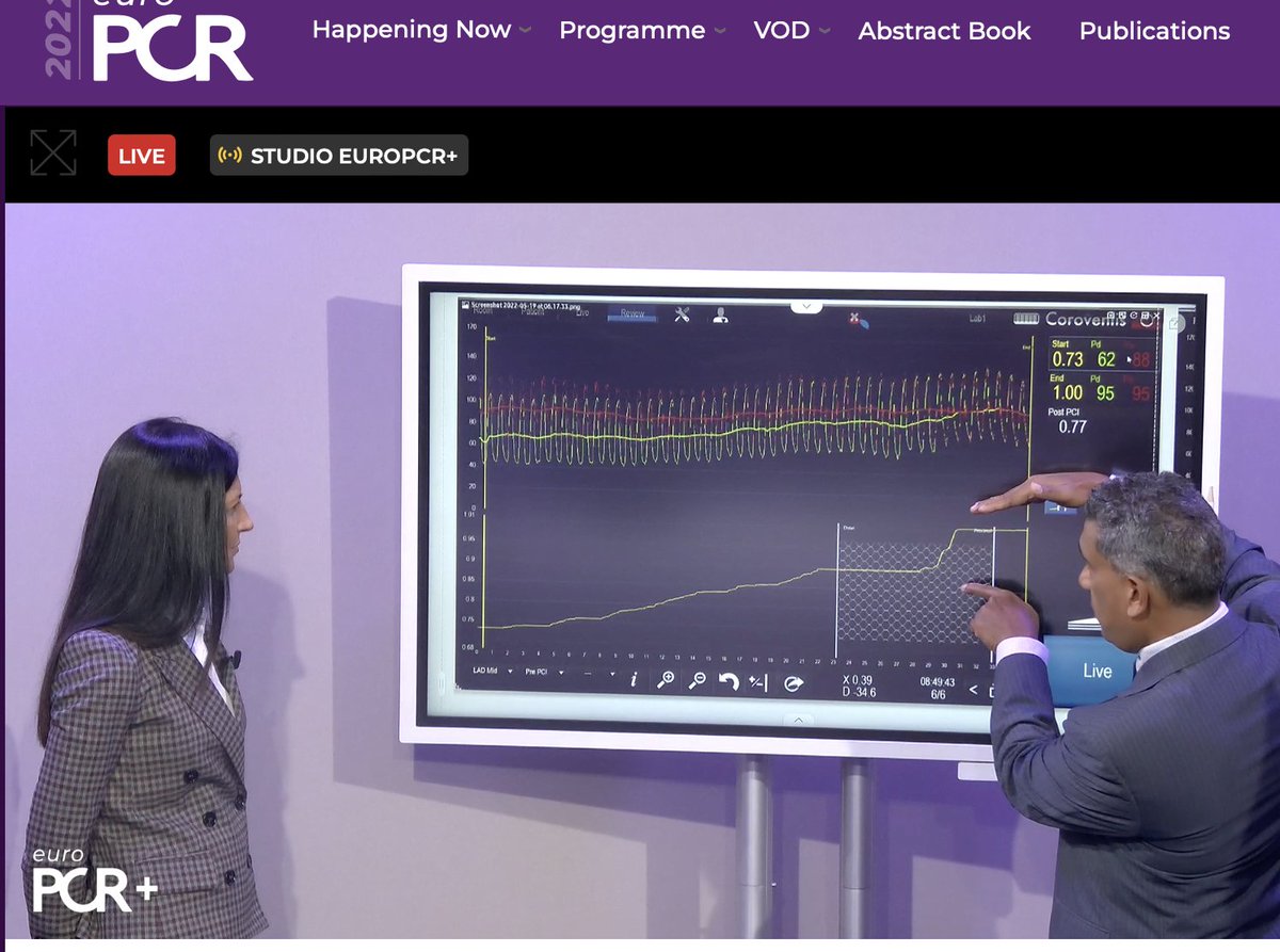 Cardiac Research (@ukheartresearch) on Twitter photo What's new in multivessel disease - a closer look on intracoronary guidance live now at #EuroPCR 2022
Prof <a href="/divaka_perera/">Divaka Perera</a> demonstrating how best to assess tandem lesions and the SERIAL Trial. What's new in multivessel disease - a closer look on intracoronary guidance live now at #EuroPCR 2022
Prof <a href="/divaka_perera/">Divaka Perera</a> demonstrating how best to assess tandem lesions and the SERIAL Trial.