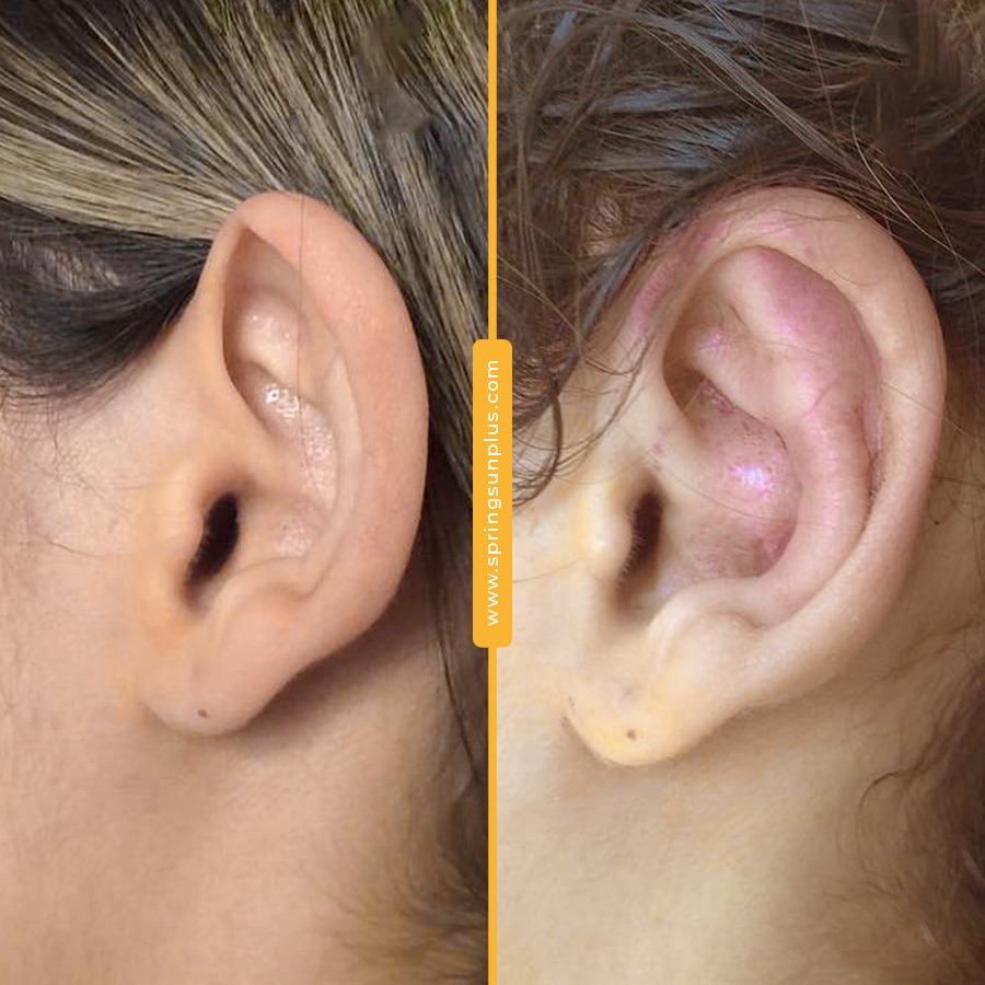 springsunplus's tweet photo. Prominent Ear Surgery (Otoplasty) in Turkey
#earsurgery #prominentearsurgery #earsurgeryturkey #otoplasty #springsunplus #turkey #healthtourism https://t.co/0TZqXu5vtd