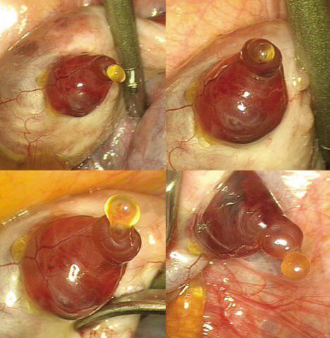 mishalmedico's tweet photo. Clearest pictures of egg leaving the ovaries(human ovulation).  It was originally thought to be quick process where the egg bursts out of the ovary. Instead, it took fifteen minutes for the ovary to fully release the egg, more like a secretion than an explosion.  #MedTwitter https://t.co/dDYo0BVQec