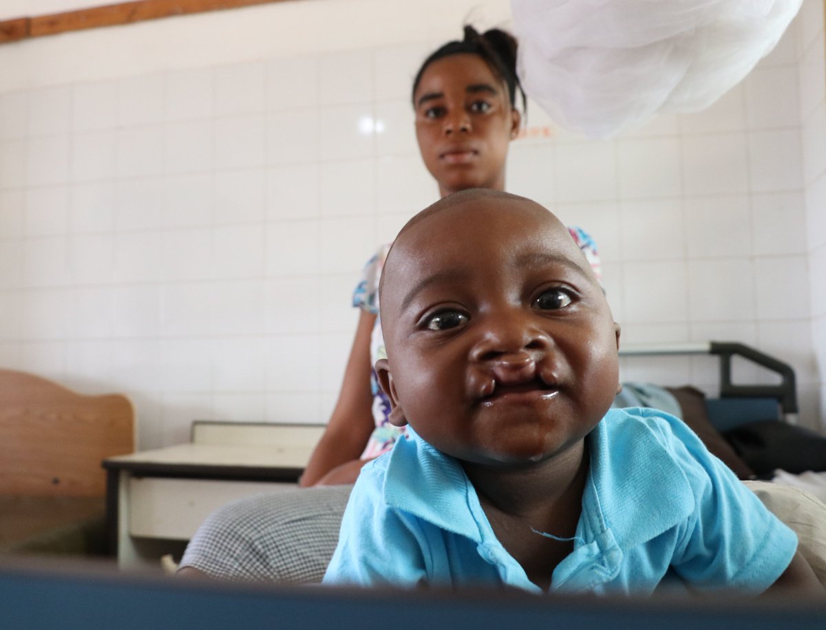 alimusamoha's tweet photo. Ukiwa unamfahamu yeyote mwenye mdomo na kinywa kilichopasuka (Kwa kimombo inafahamika kama cleft lip &amp; cleft palate) basi mpe habari na bishara njema kuwa shirika la @Smiletrain litadhamini matibabu ya upasuaji wa kurejesha hali yake ya mdomo na kinywa kuwa sawa zaidi.#monkeypox https://t.co/3G5NJvMVRQ