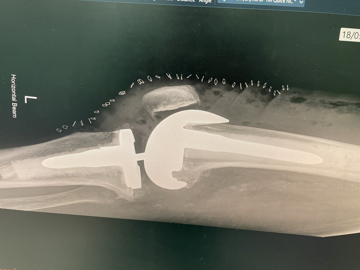 Recent Stryker TS revision mindful of the principles learnt at the recent cadaveric course in Edinburgh. Short cemented stems avoiding off-set adapters. Perhaps could have flexed the femoral component more to maximise PCO…welcome comment from <a href="/EdinburghKnee/">Chloe EH Scott</a> <a href="/DominicMarley/">Dominic Marley</a>