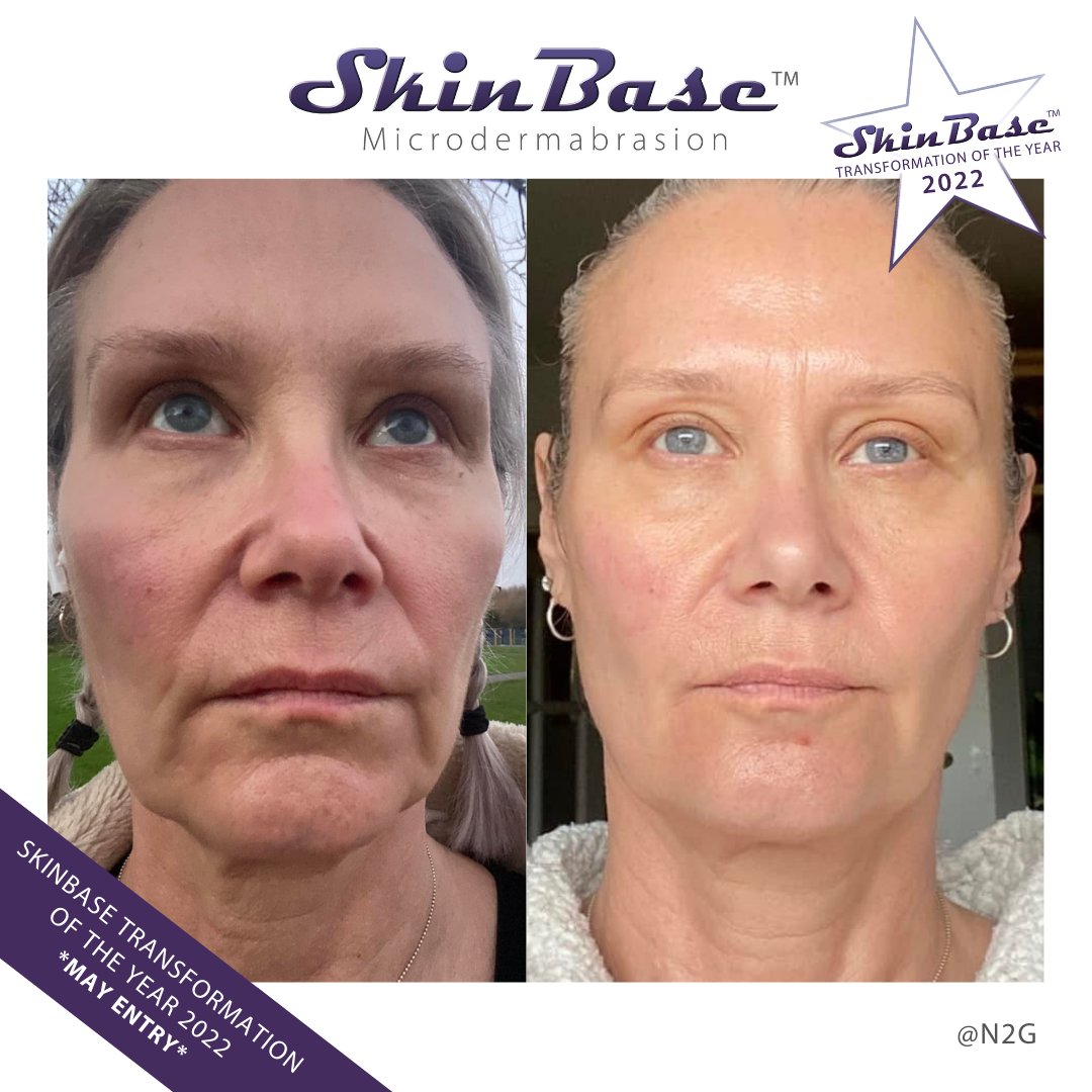 SkinBase_facial's tweet image. ⭐️ May transformation with this fabulous entry from N2G. These fantastic results were achieved through a course of 4 MD and 3 Collagen Lift treatments.

Click the link in our bio for your chance to Win a Holiday! #skinbase #microdermabrasion #collagenlift #transformation22