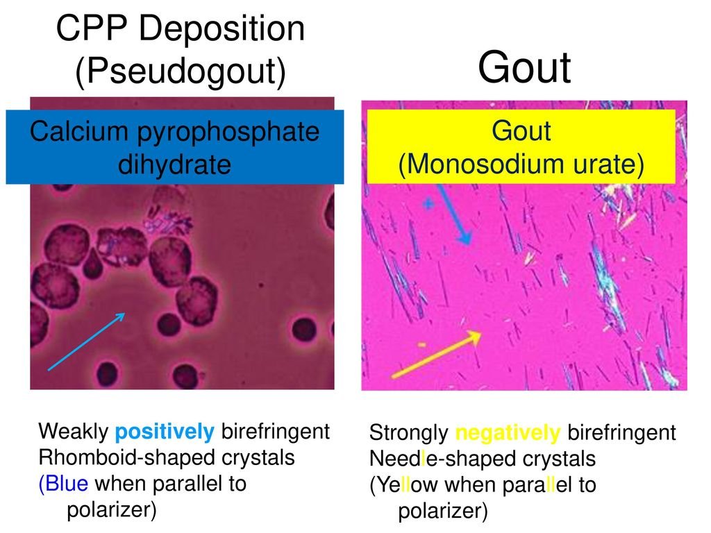 While the incidence of superimposed gout and septic arthritis is low  (~1.5%), it is reported. In the presence of crystals on aspiration, one  should not rule out the possibility of septic arthritis., image size:1024x768