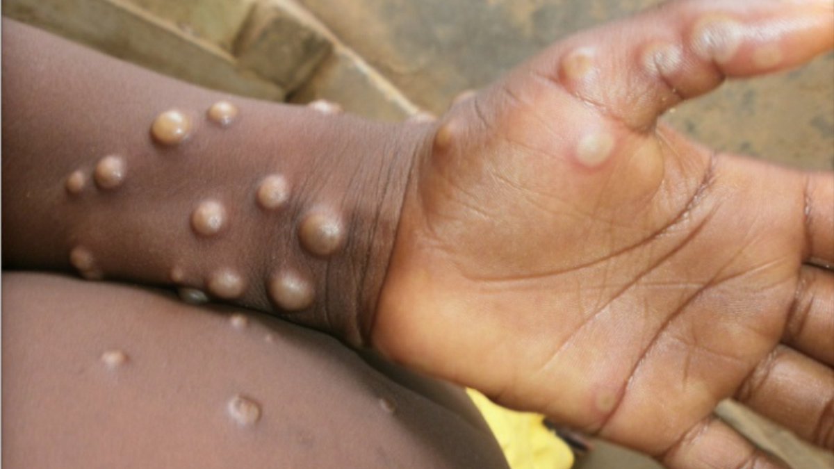 Over 6 million people died from COVID. Do we now have a new virus to worry about? Monkeypox is here. I've spent that last 24 hours scouring websites, journal articles, and expert analysis on it, so you don't have to: 🧵👇