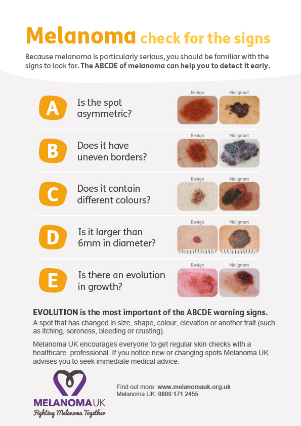 CDDFTNHS's tweet photo. Because melanoma skin cancer is particularly serious, you should be familiar with the signs to look out for. The ABCDE of melanoma can help you to detect it early. #skincancerawarenessmonth
@MacmillanCDDFT  @SkcinCharity  @MelanomaUK @HealthySkin4All https://t.co/Ao2alMfcVG