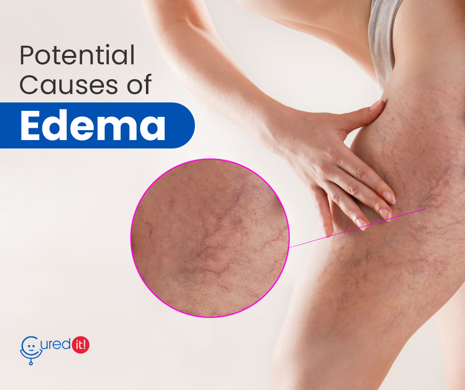 curedit's tweet photo. Sometimes an excess amount of fluid finds no outlet and may get stuck in the body tissue. This condition causes edema. Many reasons are there causing edema, such as sitting in one position for many hours, use of excess salt in food during pregnancy, or menstrual cramps.
#Curedit https://t.co/QuwrgbhHnZ