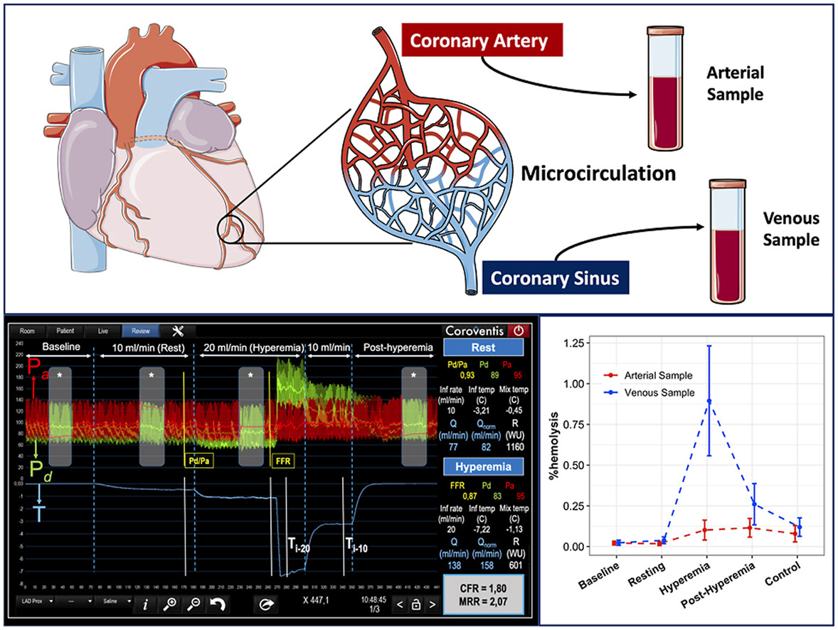 ATHjournal's tweet photo. 👉Saline-induced #hyperemia thru a dedicated intracoronary infusion catheter is assoc w/ hemolysis
👉Vasodilatory compounds locally released are likely ultimately respons 4 localized microvascular #vasodilation
Read the last #ATH📜 by @EGallinoro &Coll ⤵️
https://t.co/GWhA4l0Cdb https://t.co/vmnhIMEmqw