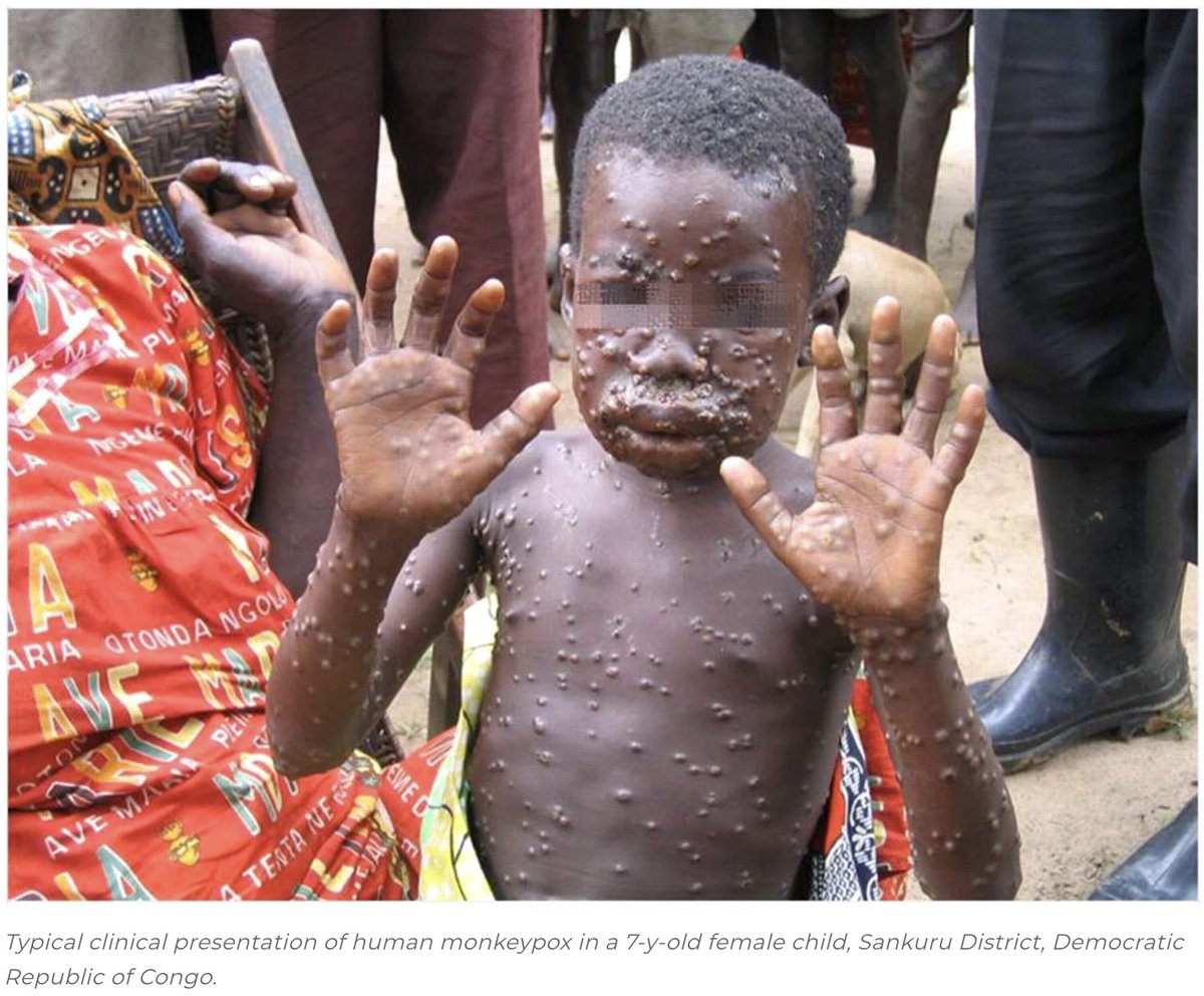 "¿Qué tienes que saber sobre el #monkeypox?"

Es una zoonosis causada x el virus monkeypox, del grupo de los orthopoxvirus, cuyo reservorio son primates y roedores pequeños de los bosques tropicales de Africa Central donde es endémica.

Tiene una letalidad <10% (0% en EEUU)