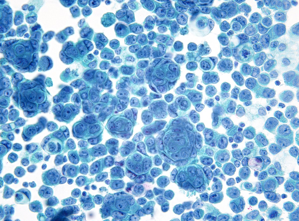 "Micromorules" of a metastatic "Cholangiocarcinoma" in Pleural Fluid. Near 100% of cells in the field are malignant. (Cytospin)