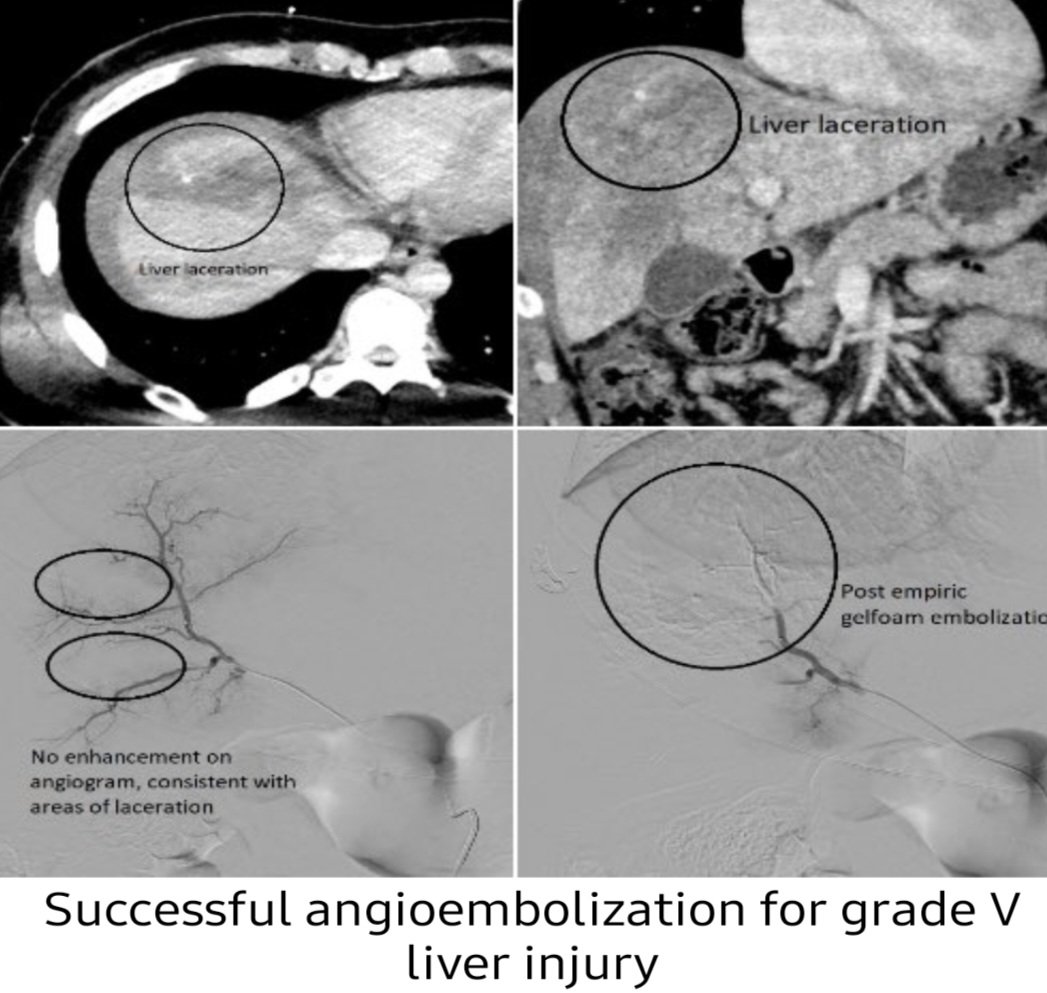 DRAFTABAHMED7's tweet photo. Management of severe liver injuries.
𝗥𝗲𝗳:Bailey and love's 27th ed
https://t.co/weG1sJi2nl
#MedTwitter #GITwitter
#liverinjury #bluntabdominaltrauma 
#damagecontrolsurgery
#pringle #angioembolization https://t.co/h5XqwThod3