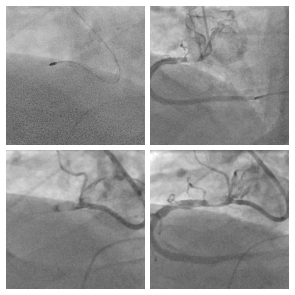 AndWierucki's tweet image. 72 year old patient with AP CCS III. Severely calcified RCA ostial stenosis. Nodal Calcium. #rotashock #crackthecalcium #IVUS #rotapro #shockwave #PCIcase @BotPci @KPujdak @kaschenke @doc_ecmo @Obisht @HolgerNef @MarcVorpahl @klinki_hh @KardiologieHH