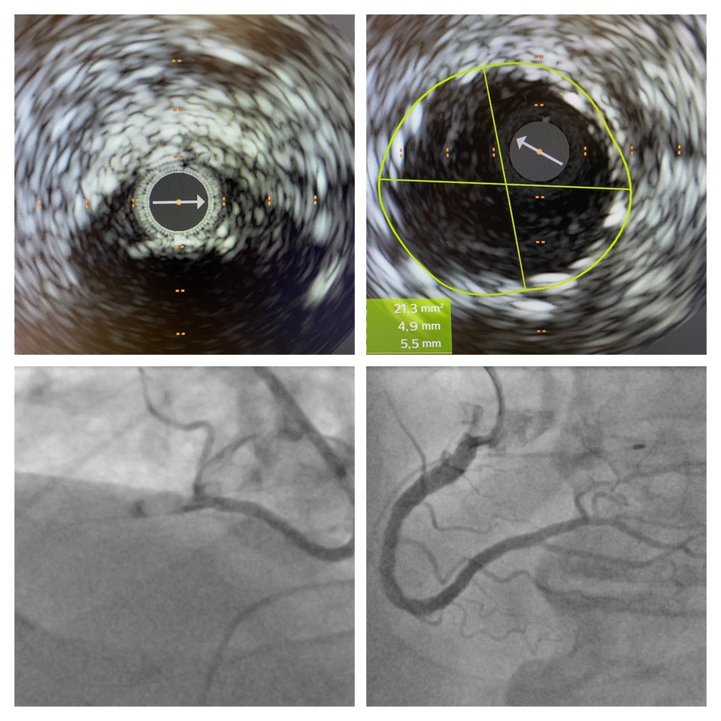 AndWierucki's tweet image. 72 year old patient with AP CCS III. Severely calcified RCA ostial stenosis. Nodal Calcium. #rotashock #crackthecalcium #IVUS #rotapro #shockwave #PCIcase @BotPci @KPujdak @kaschenke @doc_ecmo @Obisht @HolgerNef @MarcVorpahl @klinki_hh @KardiologieHH