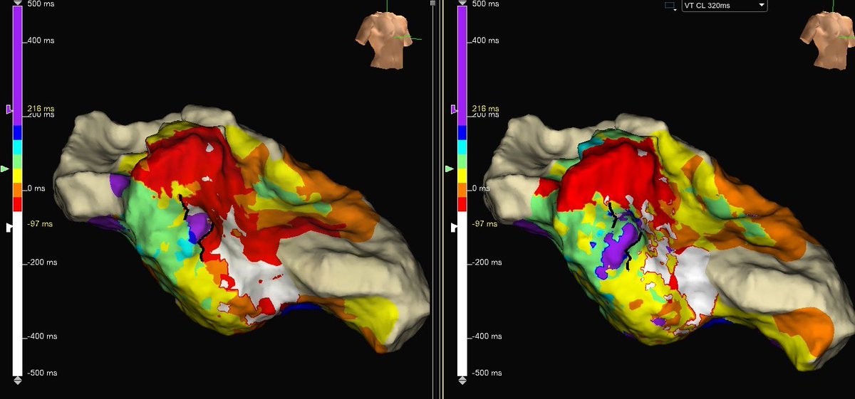 texasEPkait's tweet photo. The difference is clear in this #reentrantvt map- #omnipolar on the left, bipolar on the right! Which would you rather interpret? #ablatevt @PraveenRao_EP #hdgrid #EPeeps https://t.co/jMVlfSXWZO