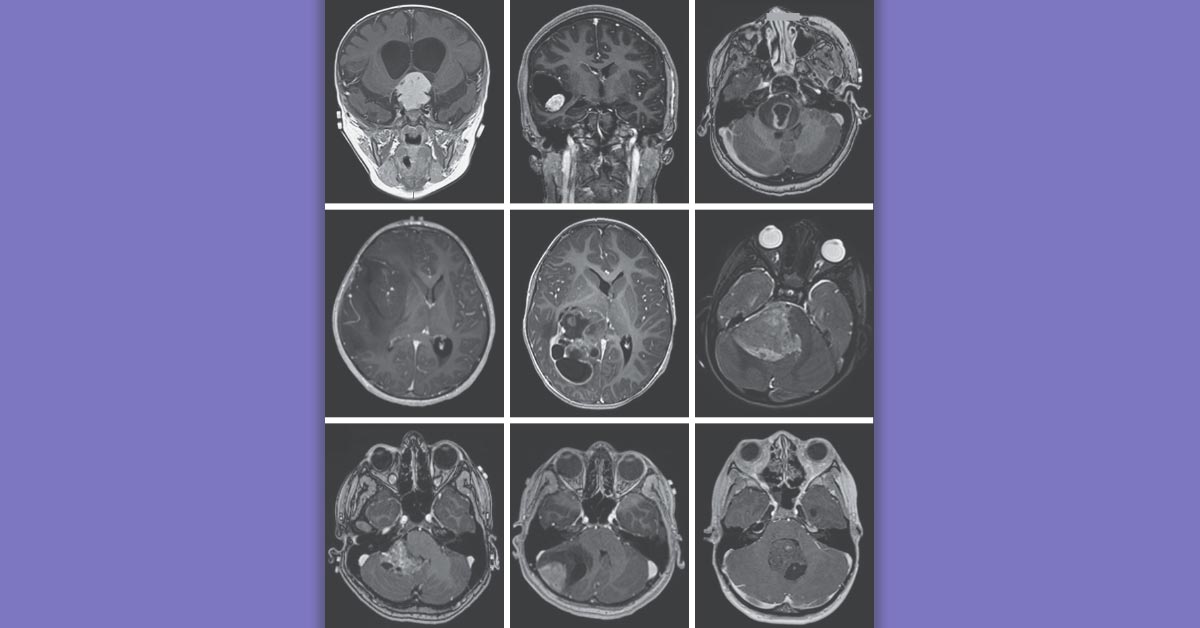 New review article highlights recent changes in the classification and management of brain tumors in children. nej.md/3witZcM