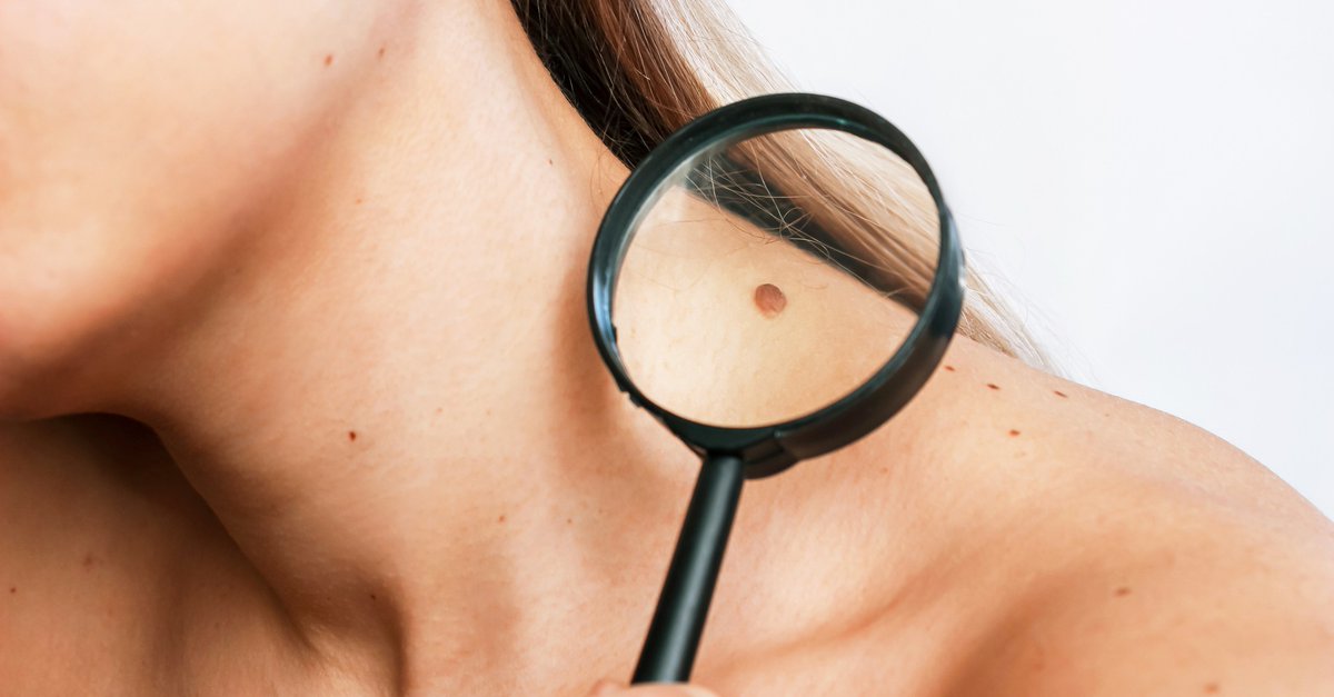 A mole that is changing in size, shape, or color, is one of the warning signs of skin cancer. bit.ly/3yI1G61  Regular self-examination of your skin may help identify early signs of skin cancer. Learn how to do a skin self-exam here bit.ly/2ylF7dI