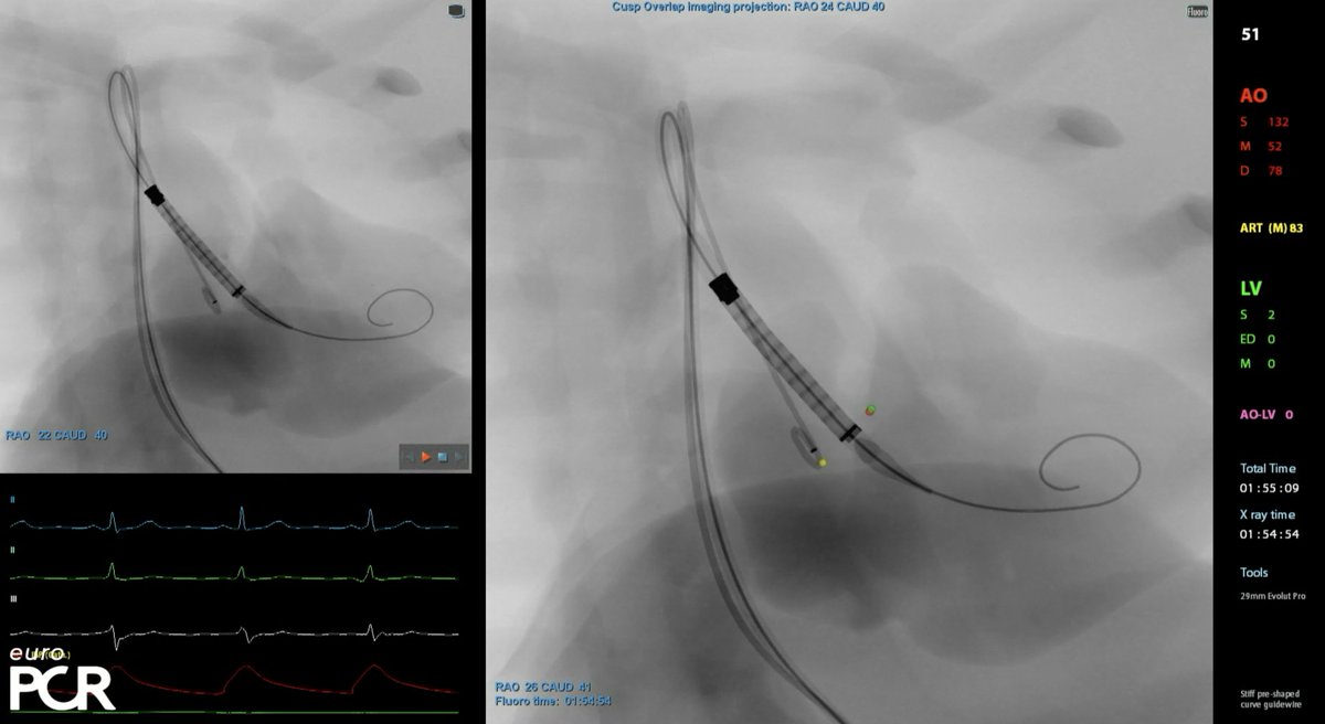 Sticchi_Alex's tweet photo. Prof @drmaisano & @nicolasdumonte1 are showing us how to achieve the best #TAVI #implantation using #CuspOverlap and #CommissuralAlignment!!
#EuroPCR 2022
@guilbon @ANazmiCalik @NicolaRyanI1 @DrArifK @mirvatalasnag @ABeneduceMD @CurioJonathan @Boleias1 @deharo_pierre @Ortega_Paz https://t.co/q2kfj9GeGu