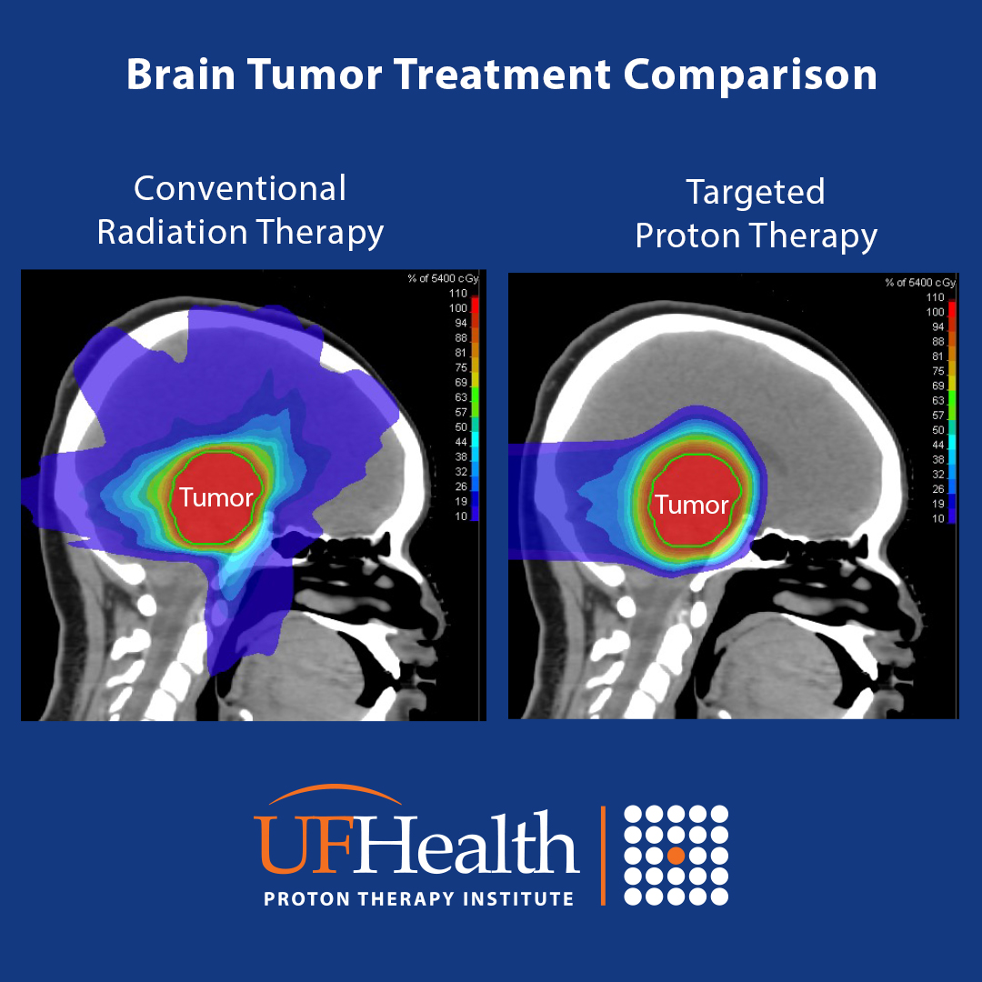 UFProtonTherapy's tweet photo. By targeting the #braintumor treatment area and avoiding normal tissue in the brain when treating brain cancer, #protontherapy can decrease the risk of new neurological deficits, hormonal deficiencies, or intellectual impairment. https://t.co/ZCqKOWCUOC #braincancerawareness https://t.co/mWi6R5pIDG