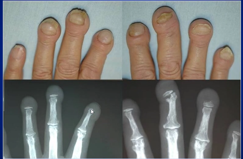 UTSWRheum's tweet photo. Name this xray finding where there is an inflammatory response of the synovium to free floating bone or foreign body fragments. https://t.co/IAbRiYY89M