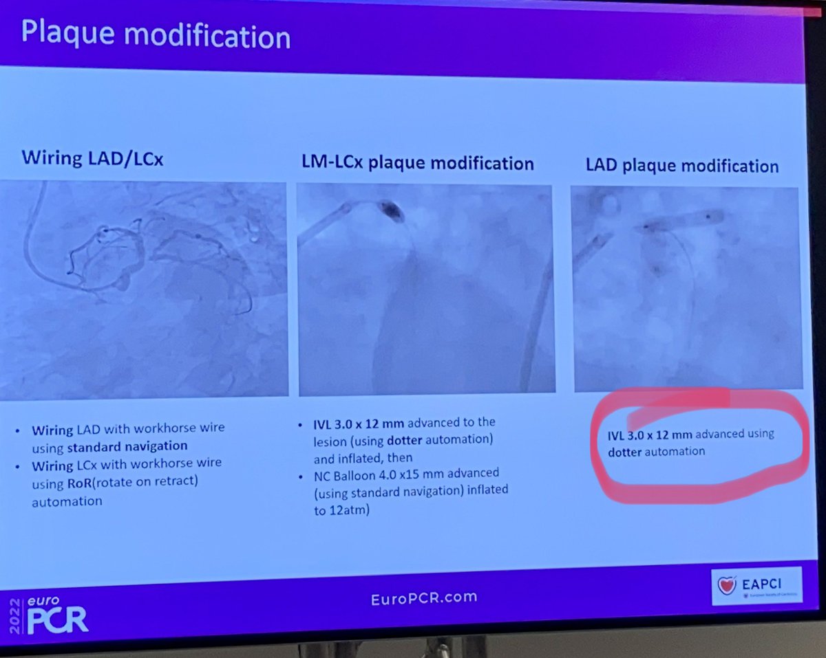 LPernasett's tweet photo. Left main and bifurcation PCI in NSTEMI. #roboticPCI case. Calcified LM & two stents technique. IVL compatible #euroPCR #clinicalcases #EuroPCR2022 https://t.co/Q3oE80HQtR