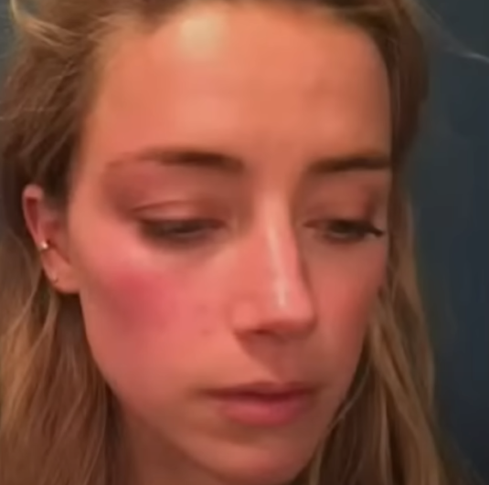 MPedrams's tweet photo. I work in visual effects. After hearing Ambers testimony that these 2 photos are different lighting I decided to take a closer look. 

I have superimposed a striped comparison of the two. They are the exact same. Liar. 

#AmberHeardIsALiar #JusticeForJohnnyDeep https://t.co/F49ercaxgU
