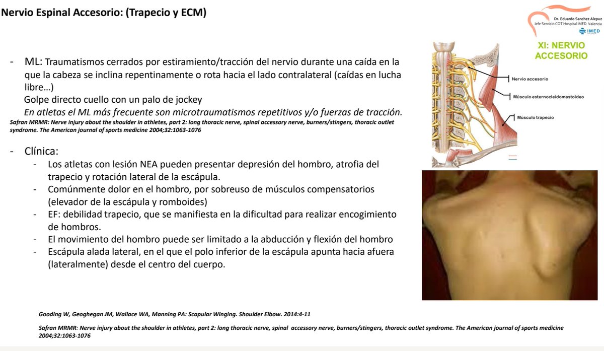 Lesiones del Nervio ESPINAL ACCESORIO en DEPORTISTAS
🏈Mecanismo Lesional: traumatismos cerrados con distracción o compresión del nervio.
🏀 Clinica: escápula alada...