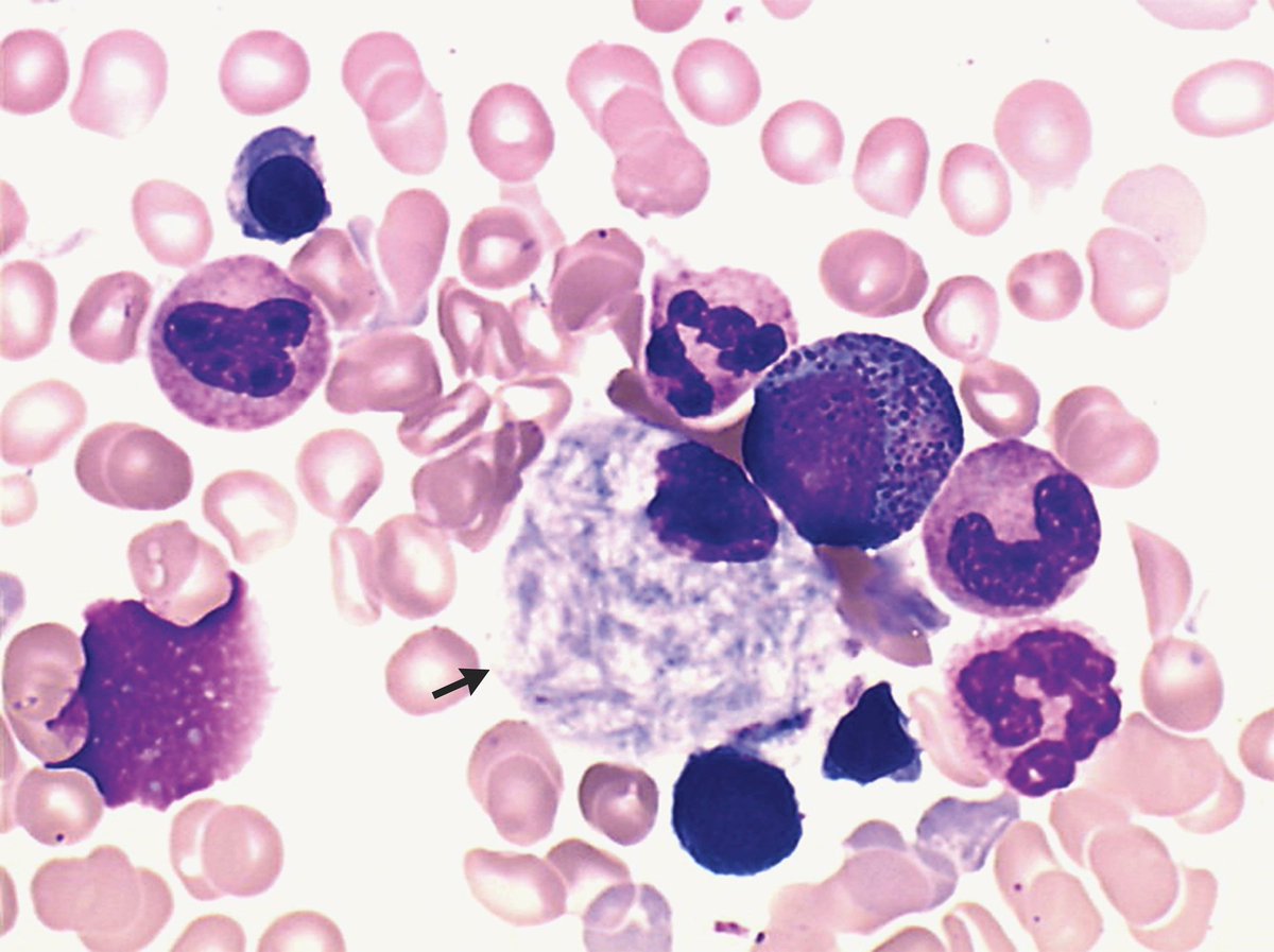 GeneticsLearn's tweet photo. Gaucher’s Disease | NEJM Image Challenge https://t.co/rtEgZIAkma https://t.co/KGl7mGF0l9