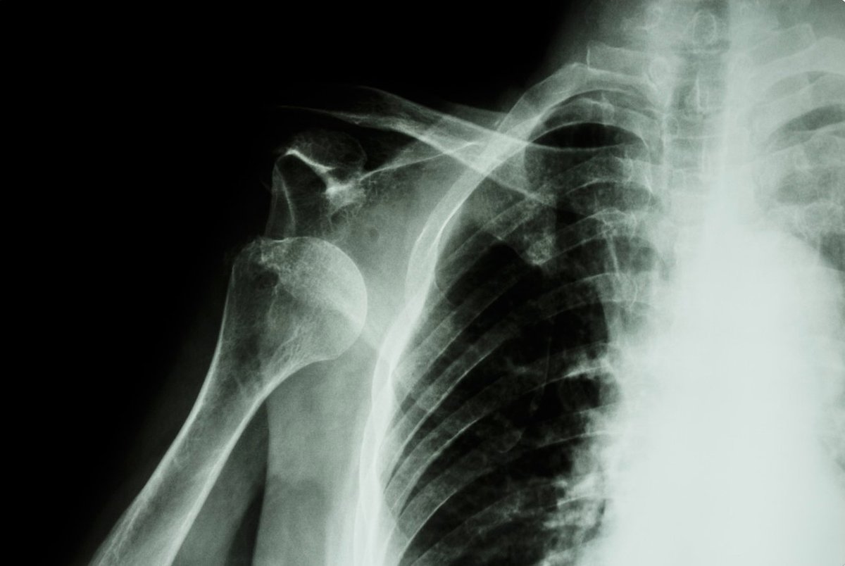 LASportsOrthoMD's tweet photo. In a 2019 survey of retired #NBA players, 27.6% of respondents reported having a #shoulderinjury during their career. #Shoulderdislocation, #acjoint injuries & #rotatorcuff injuries were the most common, followed by #labraltears and #SLAP tears. Read more: https://t.co/bCdZ9Kp2kL https://t.co/4rTCV3mu7Y