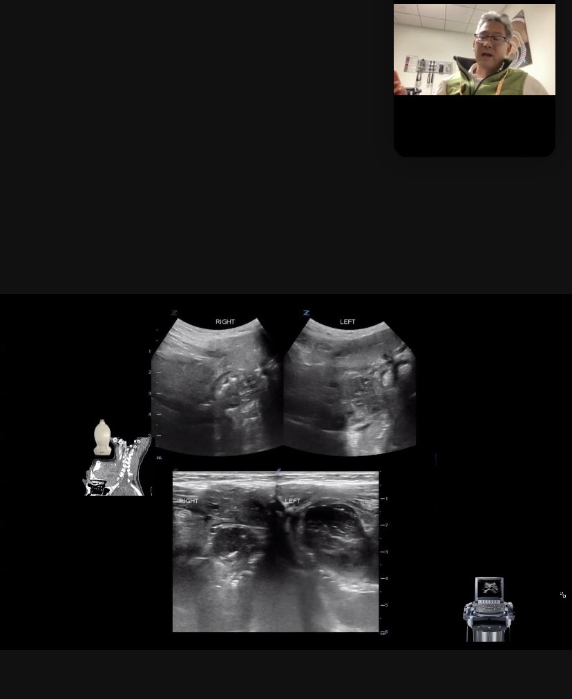 team grayscale htx (@tgs_htx) on Twitter photo The amazing Dave Teng dropping some knowledge about neck POCUS to our @TXChildrensPEM learners. Thanks for a great talk! <a href="/pocusnetwork/">P2|Network</a> <a href="/KiyettaAlade/">Kiyetta Alade</a> <a href="/pediemsono/">Beth Stone</a> <a href="/beth_damico/">Beth D'Amico</a> The amazing Dave Teng dropping some knowledge about neck POCUS to our @TXChildrensPEM learners. Thanks for a great talk! <a href="/pocusnetwork/">P2|Network</a> <a href="/KiyettaAlade/">Kiyetta Alade</a> <a href="/pediemsono/">Beth Stone</a> <a href="/beth_damico/">Beth D'Amico</a>