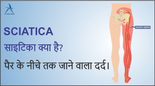 ApurvDr's tweet photo. साइटिका (sciatica) का दर्द कमर से आने वाली नस के दबाव या जलन की वजह से पीठ के निचले हिस्से से कूल्हों और पैर के नीचे होता है। यह आमतौर पर शरीर के एक तरफ को प्रभावित करता है। यह तब होता है जब रीढ़ की हड्डी का रास्ता कम हो जाता है जिससे नस पर दबाव बढ़ जाता है। https://t.co/rmhCSTAWeD