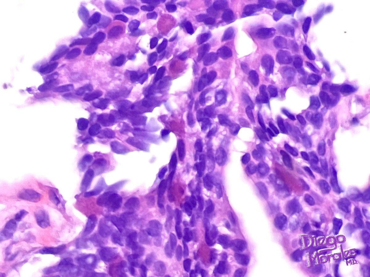DiegoMoralesN's tweet photo. Paneth cell-like change in prostate intraepithelial neoplasia (PIN).
I’ve seen it more than once in PIN (definitely more than in adenoCA)… but this one was remarkable and worth sharing.
#gupath #PathTwitter #TooPrettyNotToShare #JoyForMorphology #FreudeAnDerMorphologie https://t.co/9WxFHq12ZM