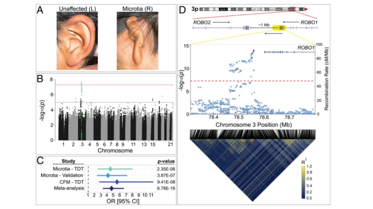 VUMC Otolaryngology–Head and Neck Surgery (@vanderbiltent) on Twitter photo Published in <a href="/PNASNews/">PNASNews</a>, researchers used #genome sequencing and found a genetic basis for the prevalence of isolated #microtia and other #craniofacial abnormalities in Amerindigenous populations. <a href="/EaveyRon/">Ron Eavey</a> <a href="/EbenRosenthal/">Eben L Rosenthal, MD</a> <a href="/EarCommunityOrg/">Melissa Tumblin</a> <a href="/ScottStephanFPS/">Scott Stephan</a> <a href="/dquiat/">Dan Quiat</a> Published in <a href="/PNASNews/">PNASNews</a>, researchers used #genome sequencing and found a genetic basis for the prevalence of isolated #microtia and other #craniofacial abnormalities in Amerindigenous populations. <a href="/EaveyRon/">Ron Eavey</a> <a href="/EbenRosenthal/">Eben L Rosenthal, MD</a> <a href="/EarCommunityOrg/">Melissa Tumblin</a> <a href="/ScottStephanFPS/">Scott Stephan</a> <a href="/dquiat/">Dan Quiat</a>