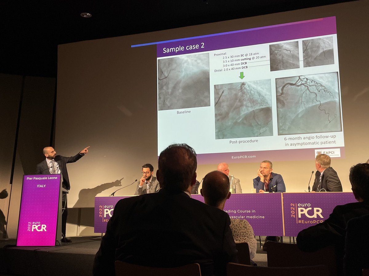 Pier Pasquale Leone (@leoneppmd) on Twitter photo Thrilling ⚡️ to present results of the U-REDUCE STENT registry @ LBT session #EuroPCR2022 <a href="/PCRonline/">PCRonline 🫀</a>
🩻 86 long coronary lesions
🪓 Thorough lesion prep
🔬 2/3 angio visible dissections
💡 NO acute vessel occlusion w/ Pd/Pa >=0.90
“Back to the future” w/ DCB angioplasty? Thrilling ⚡️ to present results of the U-REDUCE STENT registry @ LBT session #EuroPCR2022 <a href="/PCRonline/">PCRonline 🫀</a>
🩻 86 long coronary lesions
🪓 Thorough lesion prep
🔬 2/3 angio visible dissections
💡 NO acute vessel occlusion w/ Pd/Pa >=0.90
“Back to the future” w/ DCB angioplasty?