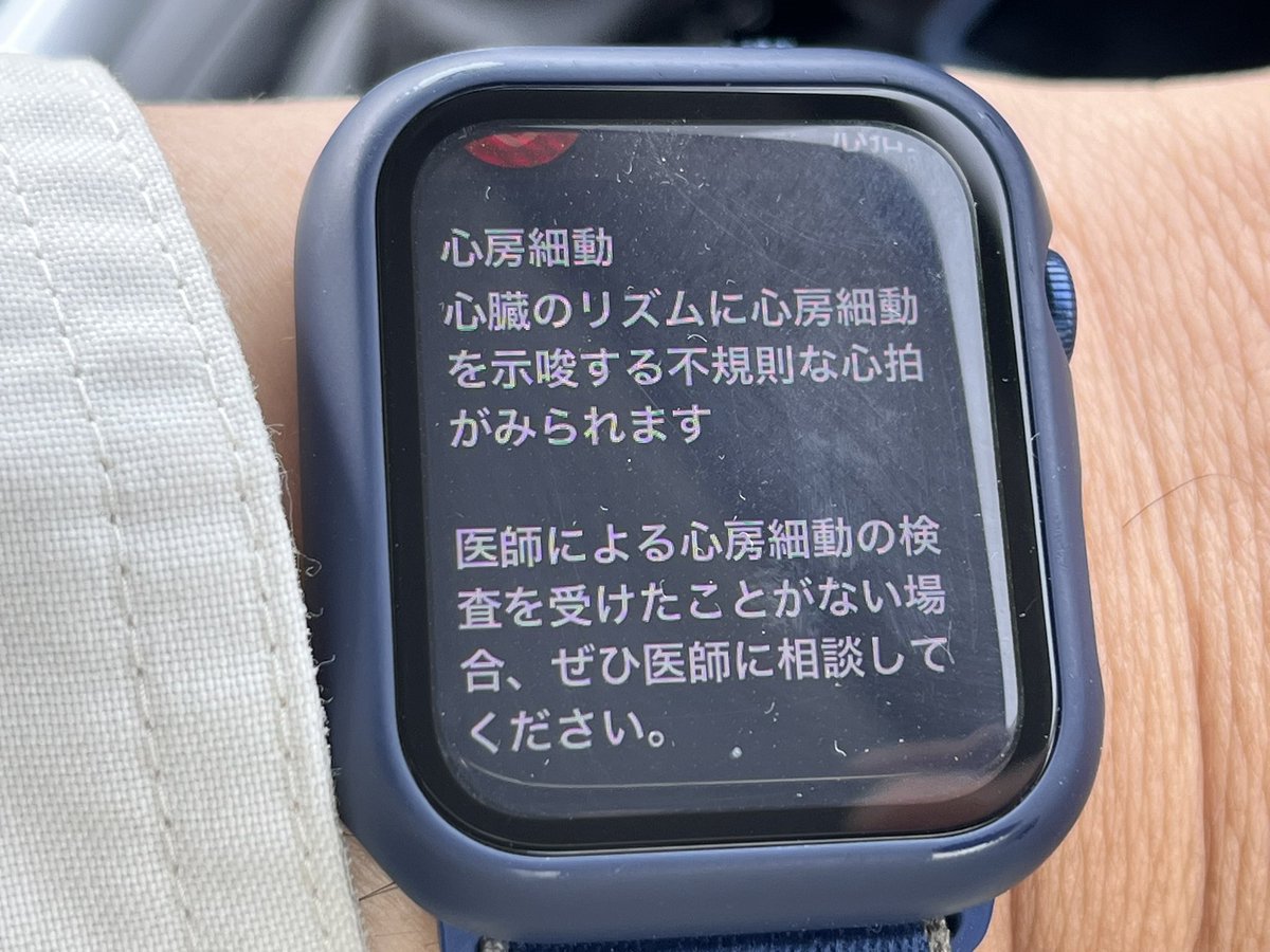 Apple Watch 心臓のリズムが心房細動っぽい 受診したら本当にアウトだった Togetter
