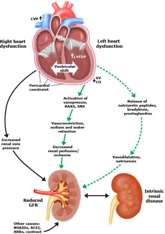 Simplistic representation of Pathophysiology of #cardiorenal disease.
Do not ignore the venous congestion component. Use #VExUS #POCUS to gather objective data.
#MedEd #Nephrology 
🔗ahajournals.org/doi/10.1161/ci…