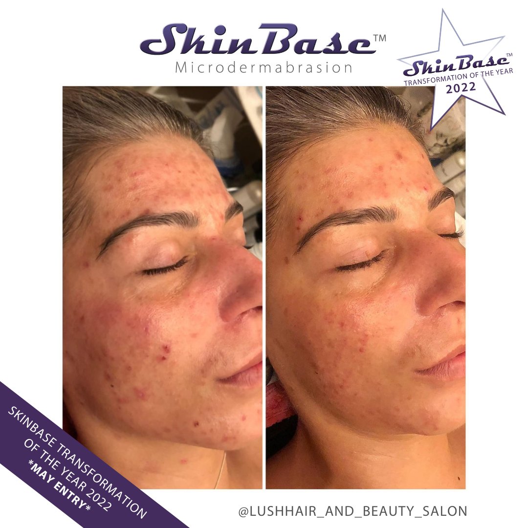 SkinBase_facial's tweet image. ⭐️ May transformation with this fabulous entry from Lush Hair and Beauty Salon. These fantastic results were achieved through a 6 treatment course of Microdermabrasion.

Click the link in our bio for your chance to Win a Holiday! #skinbase  #microdermabrasion #transformation22
