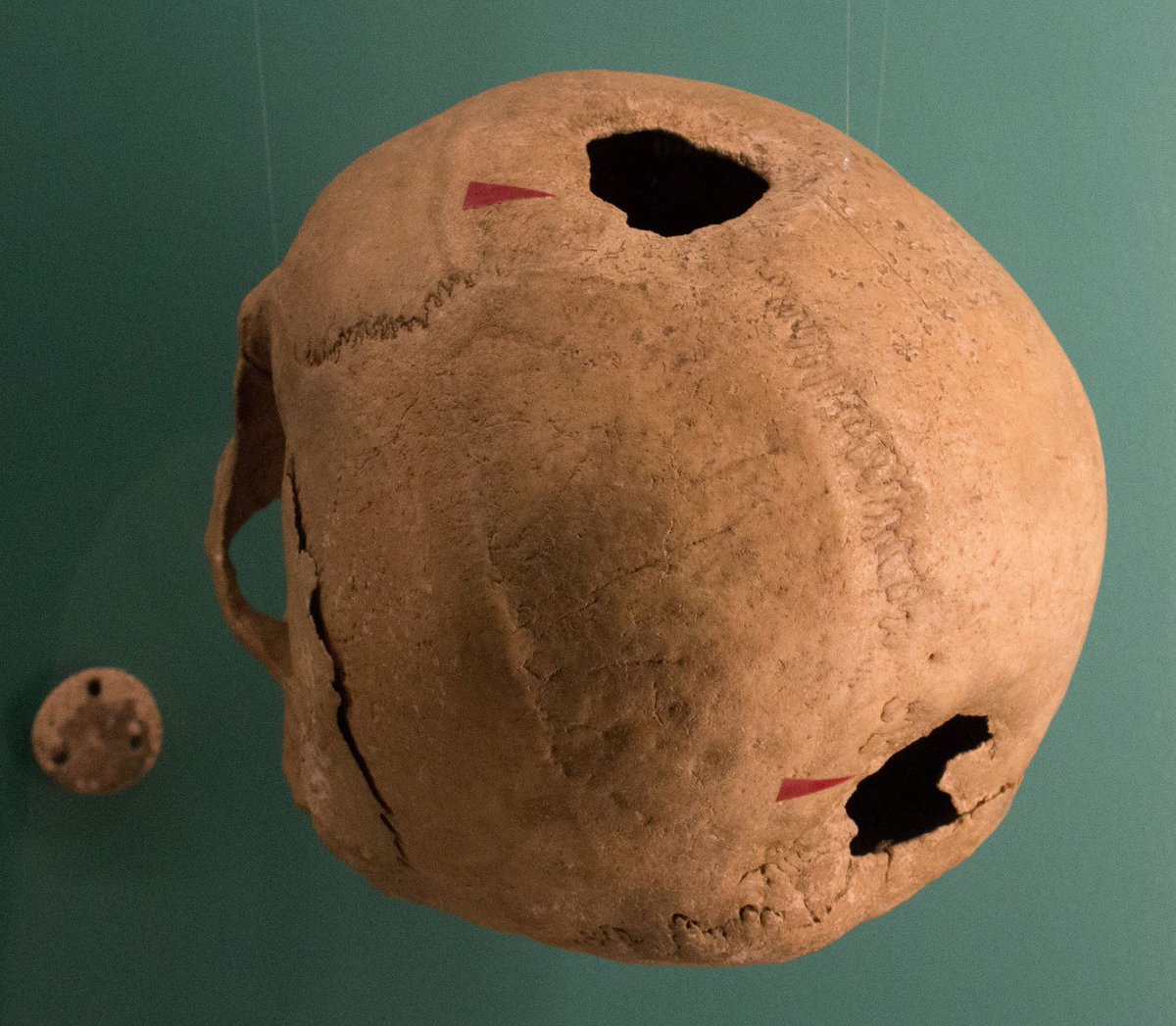 NeuKelte's tweet photo. #FaustianFriday: The skill of the #Celtic doctors is also demonstrated by the `Ovingdean Trephined Skull`. Two holes were drilled into it at different times. This means that the patient survived the 1st #trephination. The bones around the 2nd surgery had already begun to heal
1/2 https://t.co/AF4VpqFEKa