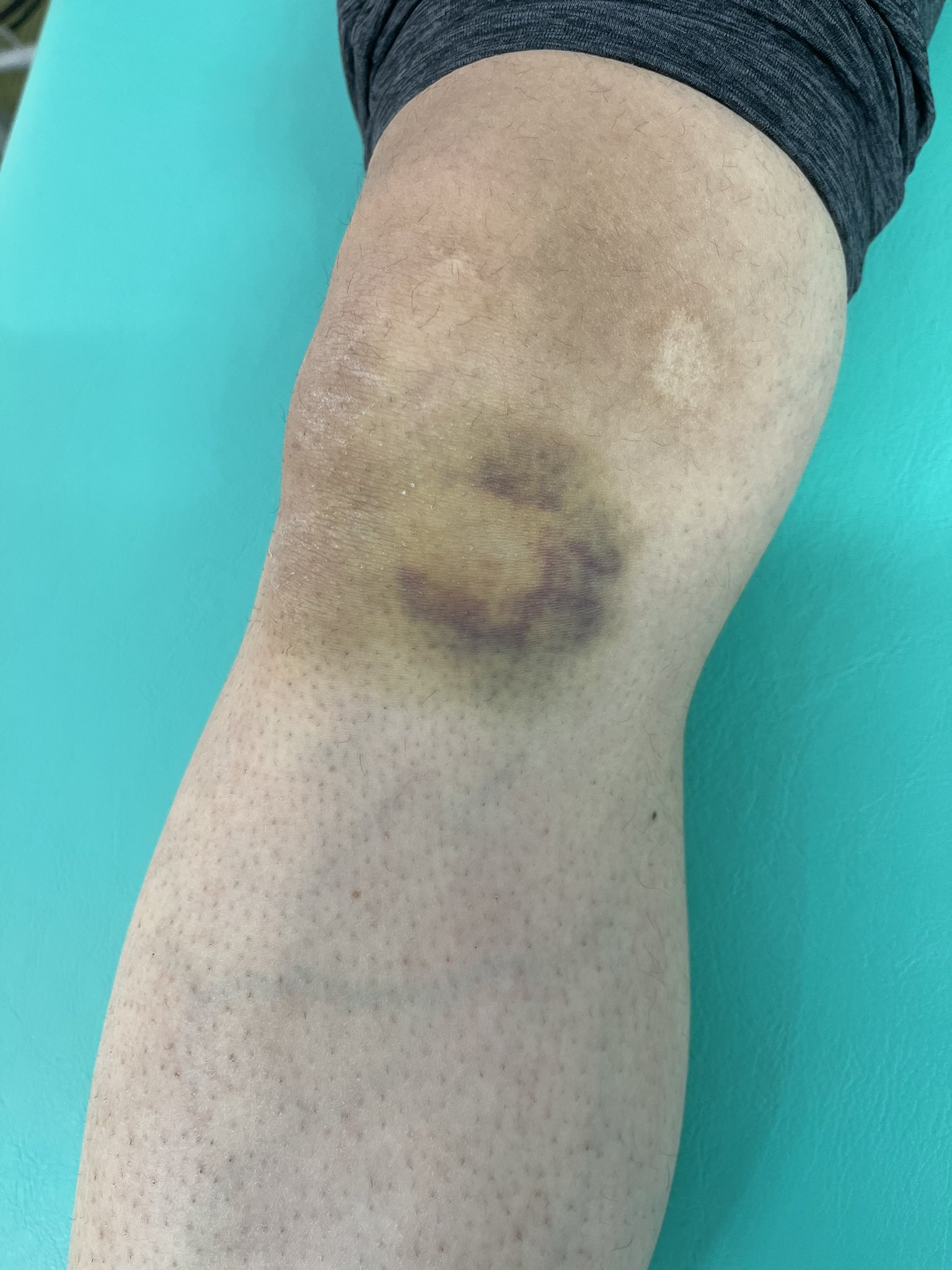 みんなの森鍼灸整骨院 横浜戸塚院 バイクで転倒した患者様の4日目です 内出血もだんだんと黄色く変化してきました 圧痛はまだありますが歩行時の痛みはほとんど気にならない様です 今は打撲 部よりもムチウチ症状の首がつらく感じています 整骨院