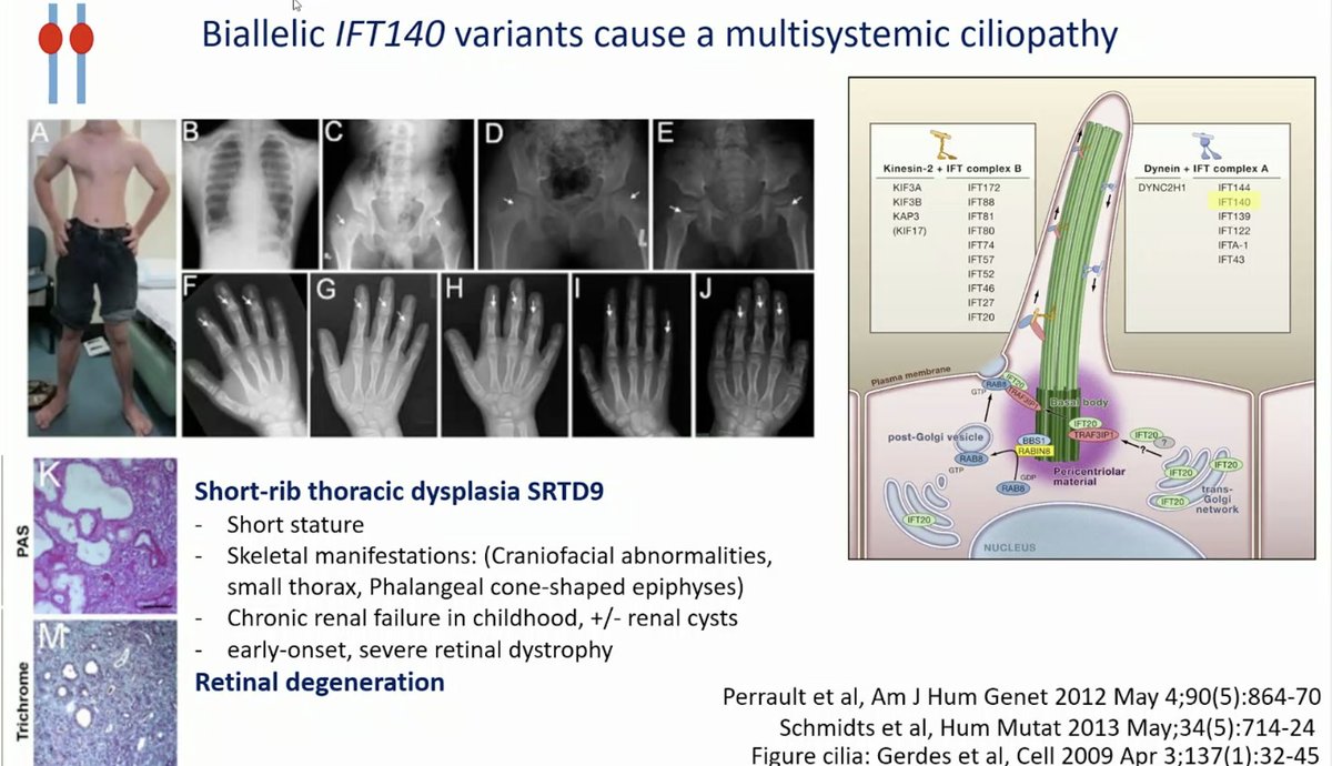 ERAkidney's tweet photo. Multiple genes are associated with overlapping cystic phenotypes. IFT140 has recently been described as a cause of mild ADPKD. Extrarenal phenotype still needs to be précised
#GENera22 #ERA22 https://t.co/9rHQ60IpLY