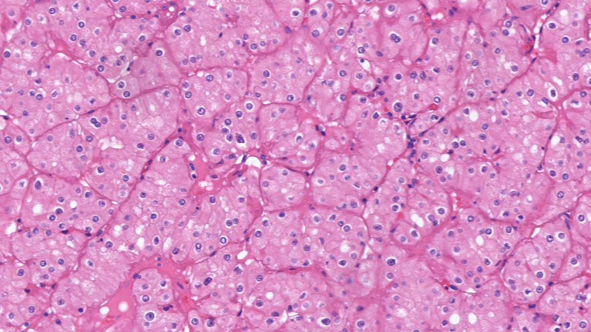 Eosinophilic chromophobe renal cell carcinoma remains difficult to distinguish from oncocytoma. However, clues can include prominent trabecular architecture and perinuclear clearing. 
#PathTwitter #Uropath #pathology #KidneyTumor #urology  #MedTwitter