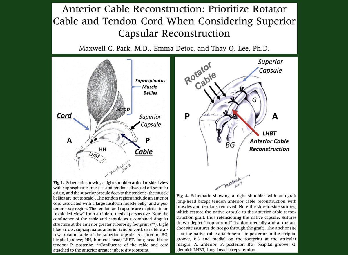 Expert opinion says prioritize rotator cable and tendon cord in superior capsule reconstruction: ow.ly/9RYn50J72PS #shoulder #rotatorcuff #SCR #arthroscopy #AANA