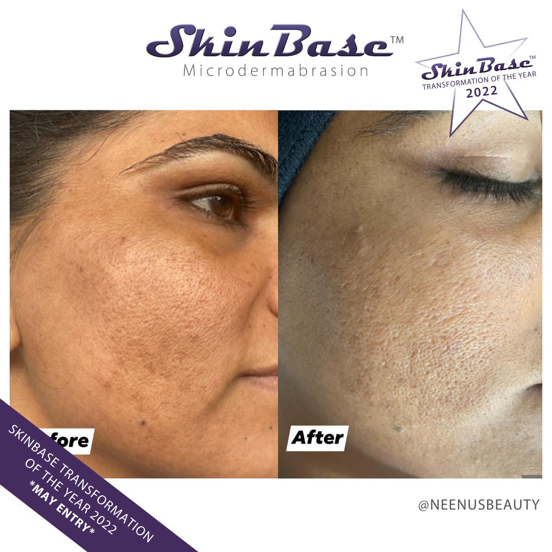 SkinBase_facial's tweet image. ⭐️ May transformation with this fabulous entry from Neenu's Beauty. These fantastic results were achieved through a mini course of Microdermabrasion.

Click the link in our bio for your chance to Win a Holiday! #skinbase #microdermabrasion #transformation22