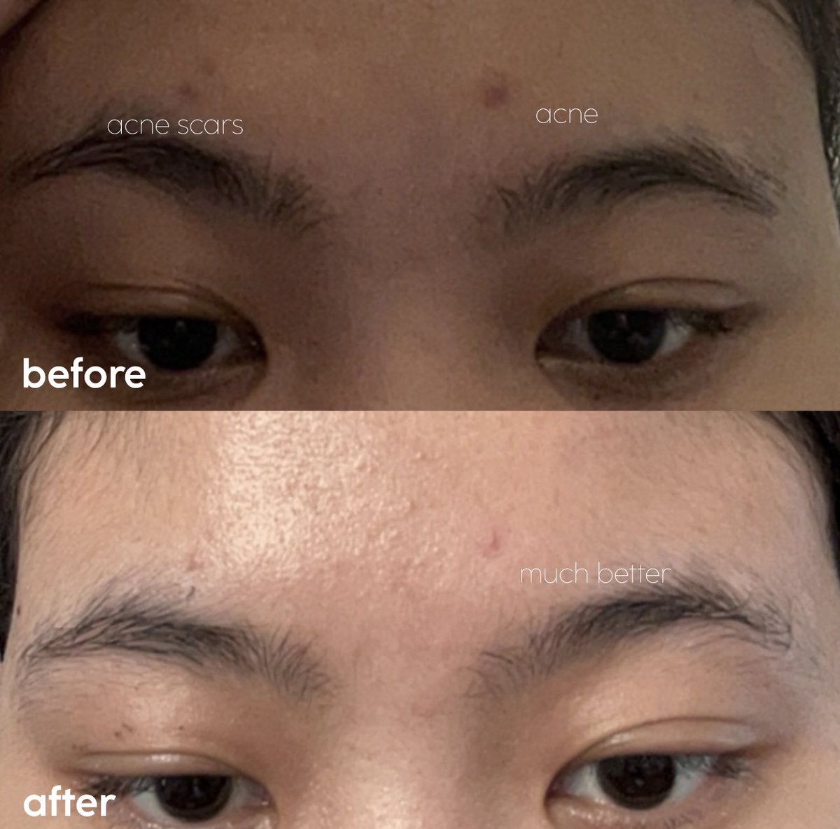 dua serum penyelamat aku pas breakout kemarin. keduanya kasih hasil yang berbeda: recovery jerawat &amp; bantu pudarkan bekas jerawat.

buat kalian yang lagi cari serum untuk menyembuhkan jerawat serta bekasnya, bisa baca &amp; save thread ini untuk referensi ♡