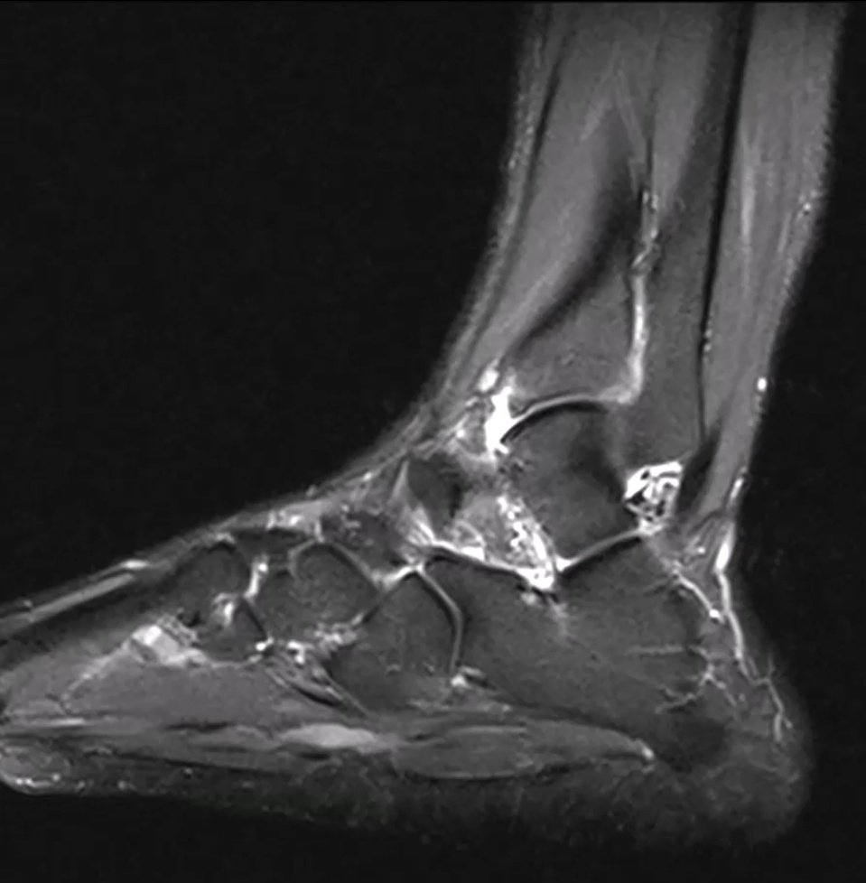 drjoseptorrent's tweet photo. 51 Curso de enfermedades de los Pies A. Viladot. Conversamos sobre las posibilidades de la Artroscopia anterior de tobillo. #impingent #tobillo #artroscopia
@institutrabat @videosdmedicina @MiTresTorres @traumagrup https://t.co/4adTBmwfHh