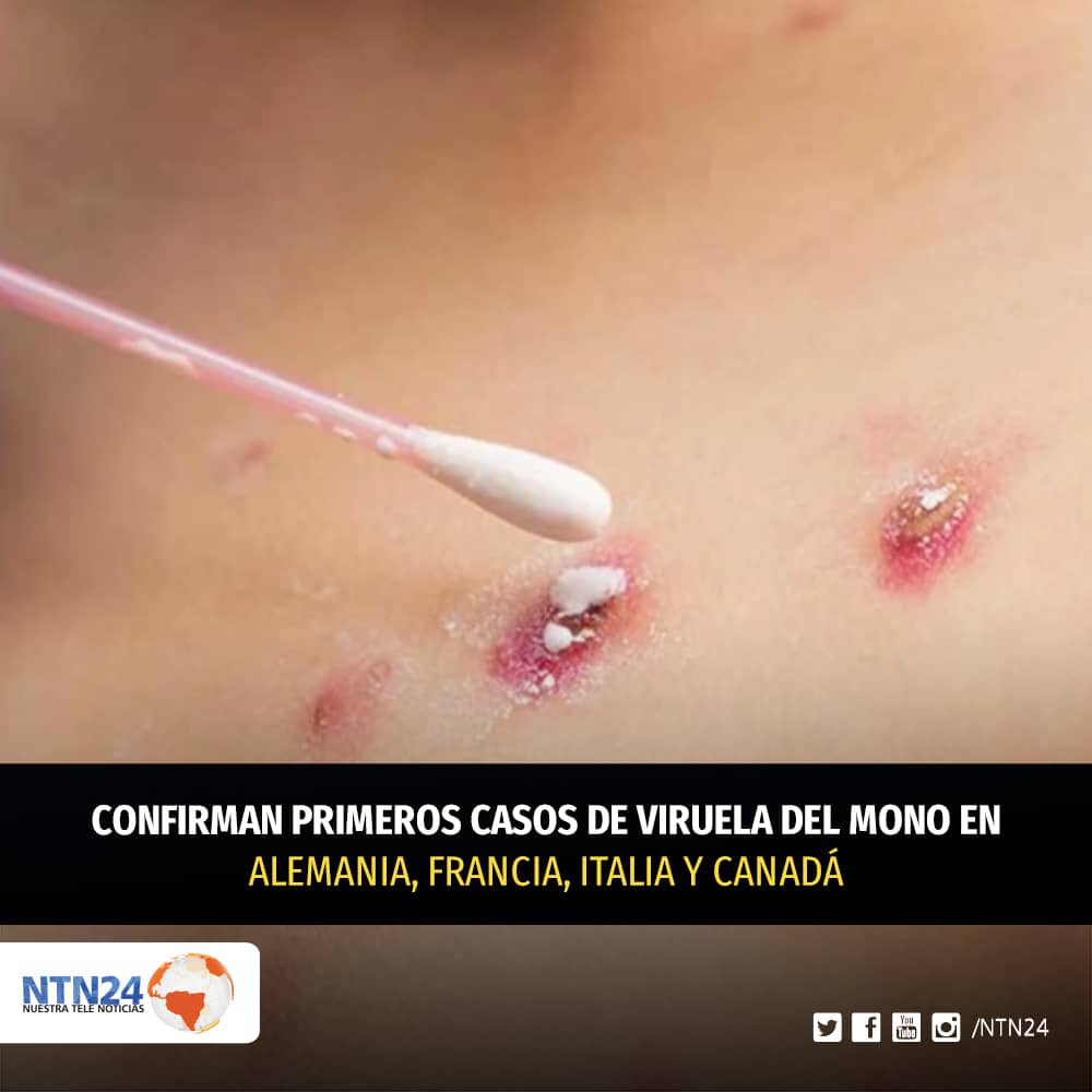 NTN24's tweet photo. Alemania, Francia, Italia y Canadá confirman los primeros casos de la viruela del mono en humanos
https://t.co/286rEjf2LA https://t.co/RqWOjTnReR