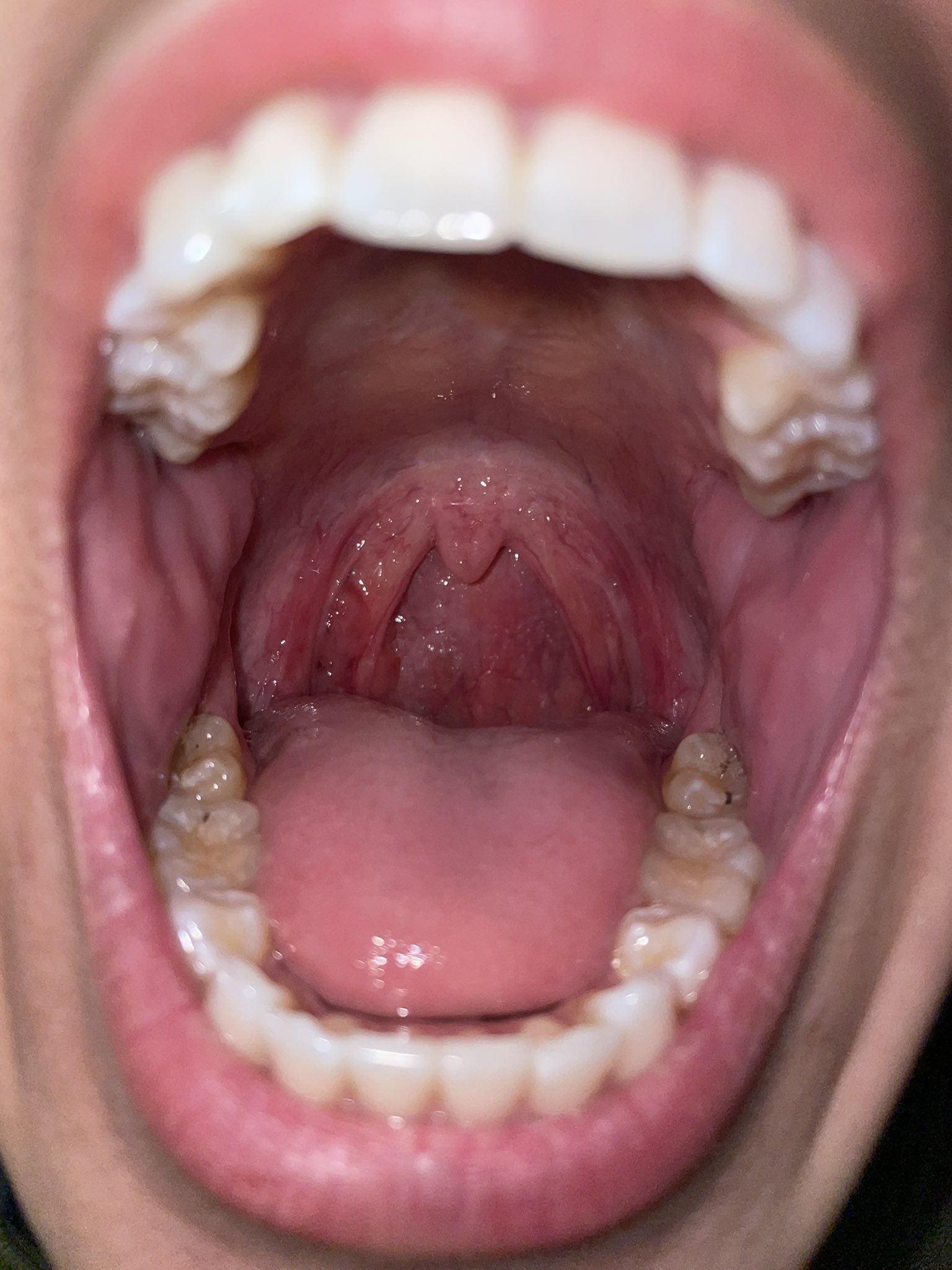 Alyssa on Twitter "Look at my little flappy uvula haha https//t.co